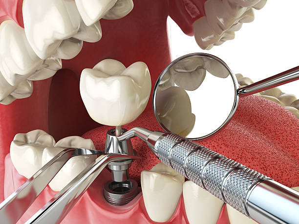 Best Urgent Care for Lost Fillings or Crowns in Lus Valley Marinwood, CA
